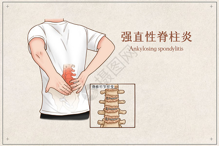 强直性脊柱炎医疗插画高清图片