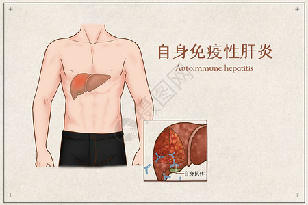自身免疫性肝炎医疗插画高清图片