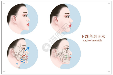 下颌角纠正手术医学医美插画图片