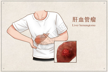 肝血管瘤医疗插画高清图片