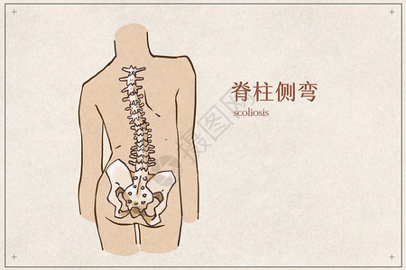 人体示意图脊柱侧弯病例插画