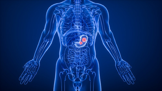 3D胃部疾病高清图片
