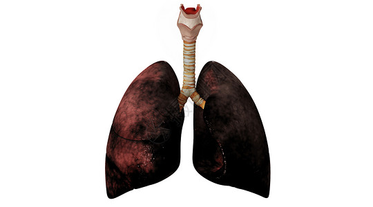肺部病变场景图片