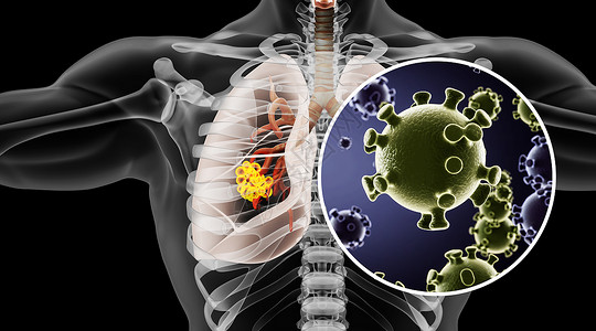 人体肺部病变场景高清图片
