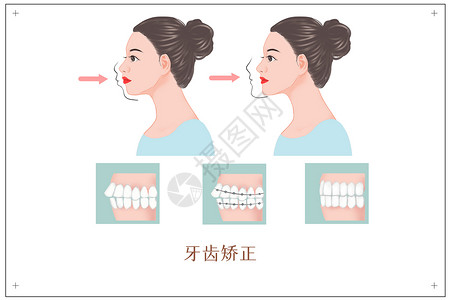 下巴整形牙齿矫正医美插画插画