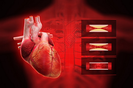 溶解血栓心脏病设计图片