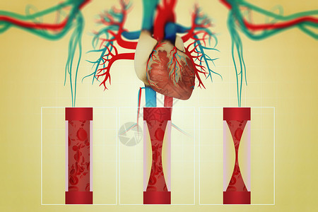 溶解血栓心脏疾病设计图片