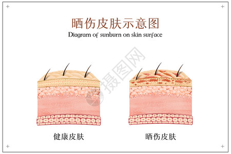 医疗护理图片晒伤皮肤示意图插画