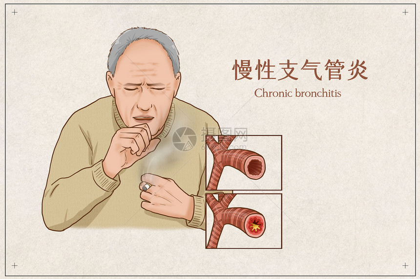 慢性支气管炎医疗插画图片