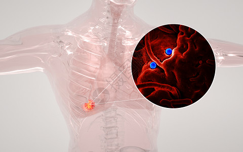 人体肺部病变感染背景图片