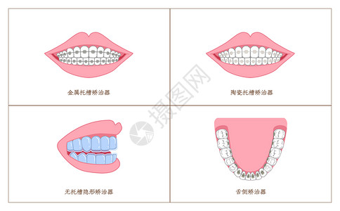 皮质材料牙齿矫正材料分类科普插画插画