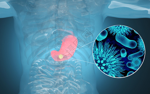 立体医疗检查人体胃部疾病设计图片