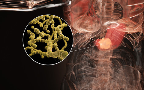 炎症细胞胃癌场景设计图片