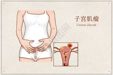 子宫肌瘤医疗插画背景图片