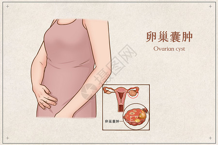 卵巢囊肿医疗插画病理高清图片素材