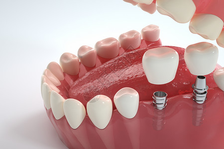 口腔临床医学医美种植牙设计图片