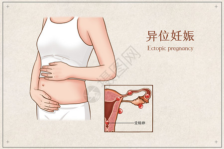 异位妊娠医疗插画高清图片