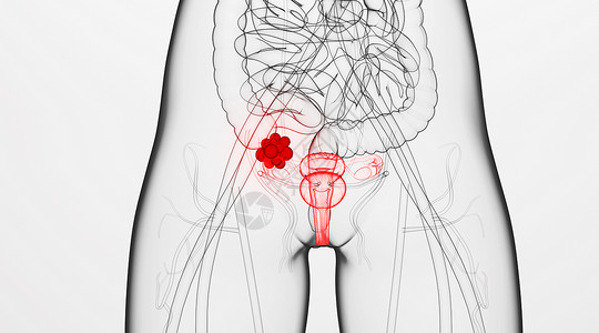 卵巢肿瘤人体卵巢病变场景设计图片