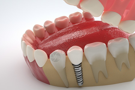 医美种植牙牙齿3D高清图片