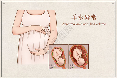 羊水穿刺羊水异常医疗插画插画
