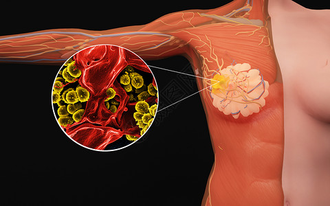 人体女性乳腺病变图片