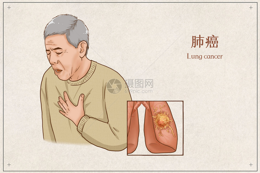 肺癌医疗插画图片