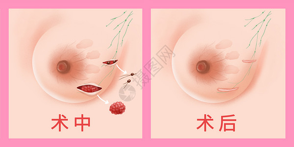 保监乳腺癌保乳手术医疗插画插画