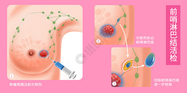 乳腺癌前哨淋巴结活检医疗插画高清图片