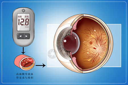 糖尿病并发症视网膜病变医疗插画高清图片