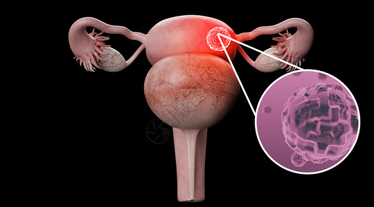 卵巢肿瘤子宫病变场景设计图片
