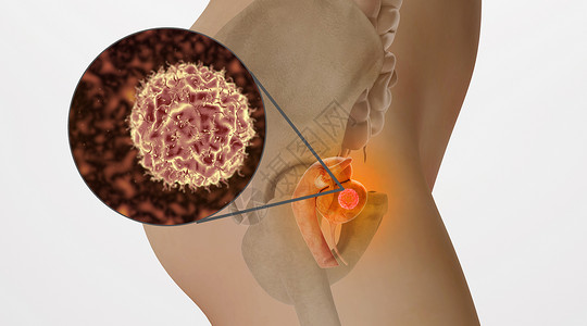 子宫健康子宫病变场景设计图片