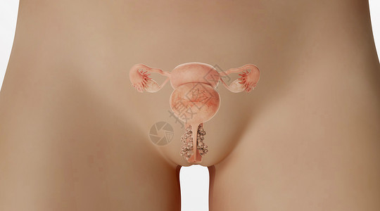 卵巢肿瘤阴道病变场景设计图片