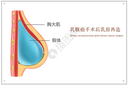 乳腺癌手术后乳房再造医疗插画背景图片