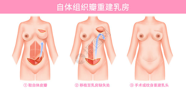 乳腺癌自体组织瓣重建乳房医疗插画背景图片