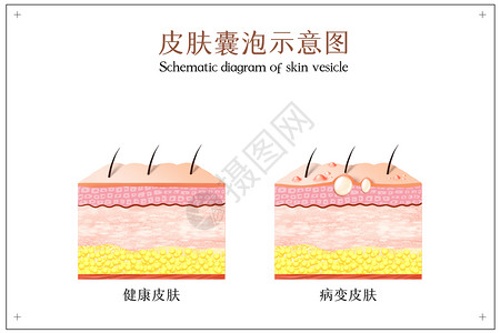 土楼泡皮肤病变之皮肤囊泡示意图插画