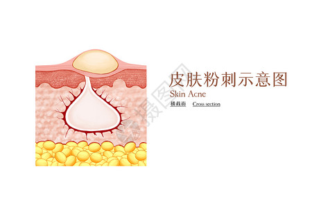 皮肤粉刺示意图背景图片