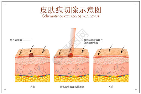 脸部激光美容面部美容去除黑痣示意图插画