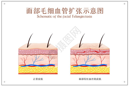 角质层薄面部红血丝示意图插画