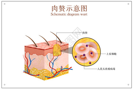 细菌结构皮肤病变之肉赘示意图插画