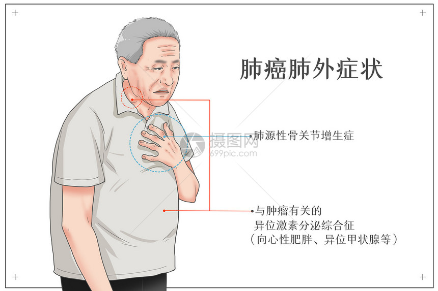 肺癌肺外症状医疗插画图片