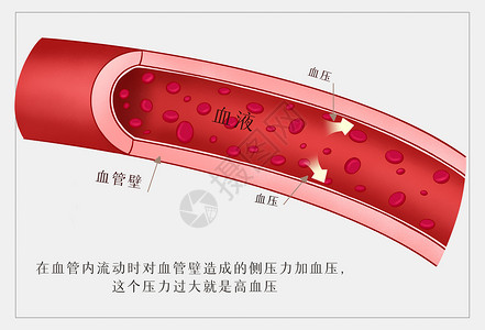 血鸭什么是高血压医疗插画插画