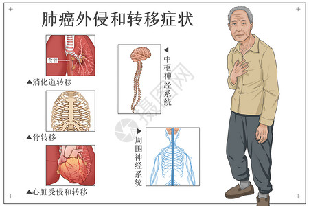 肺癌外侵和转移症状医疗插画高清图片