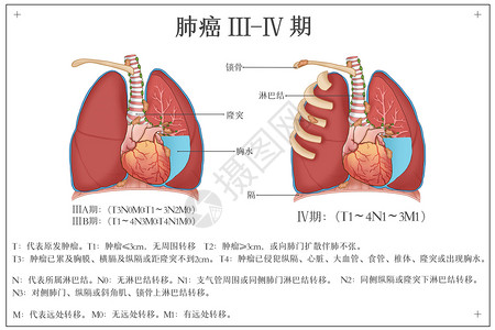 肺癌发展阶段医疗插画图片