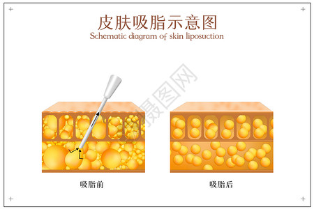 吸脂后皮肤对比示意图图片