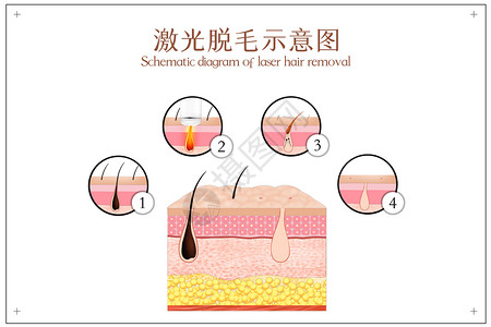 激光发射器激光脱毛示意图插画