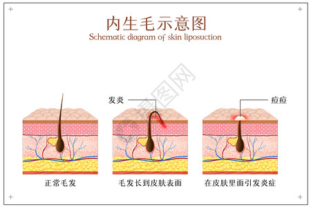 面部毛发向内生长的毛发引发皮肤炎症示意图插画