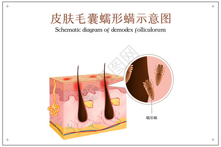 高效除螨器主图毛囊蠕形螨引发皮肤炎症插画