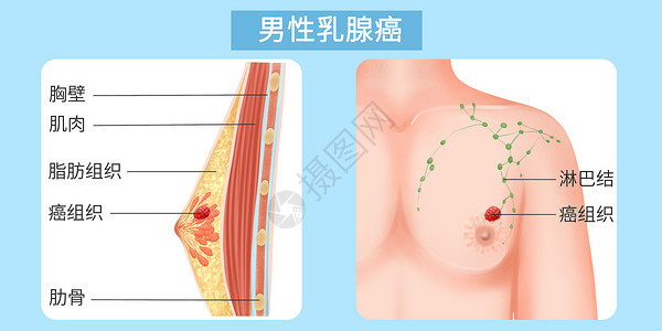 乳腺结构男性乳腺癌医疗插画插画