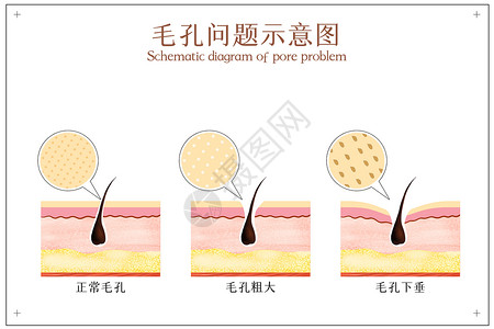 分层示意图面部毛孔问题示意图插画