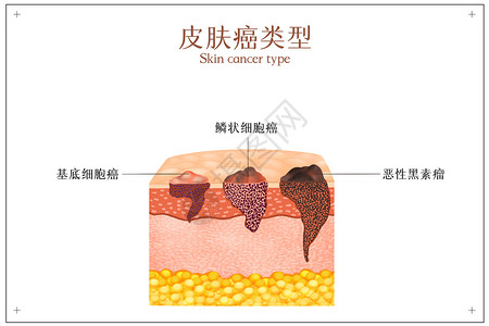 头颈癌皮肤癌症类型示意图插画
